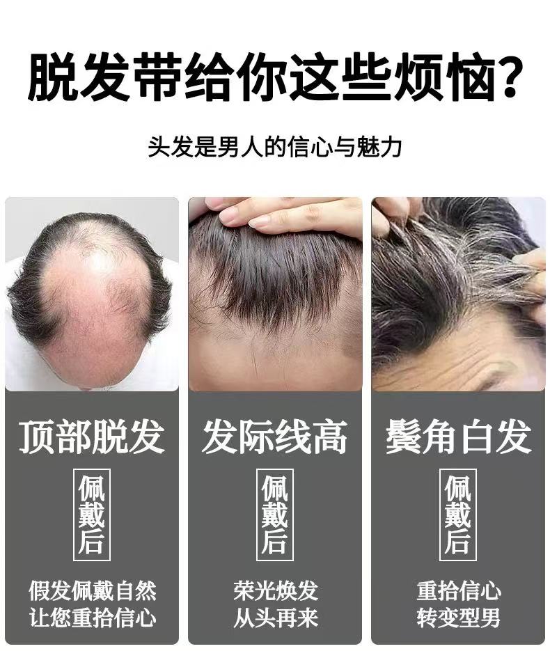脱发烦恼 - 顶部脱发、发际线高、鬓角白发